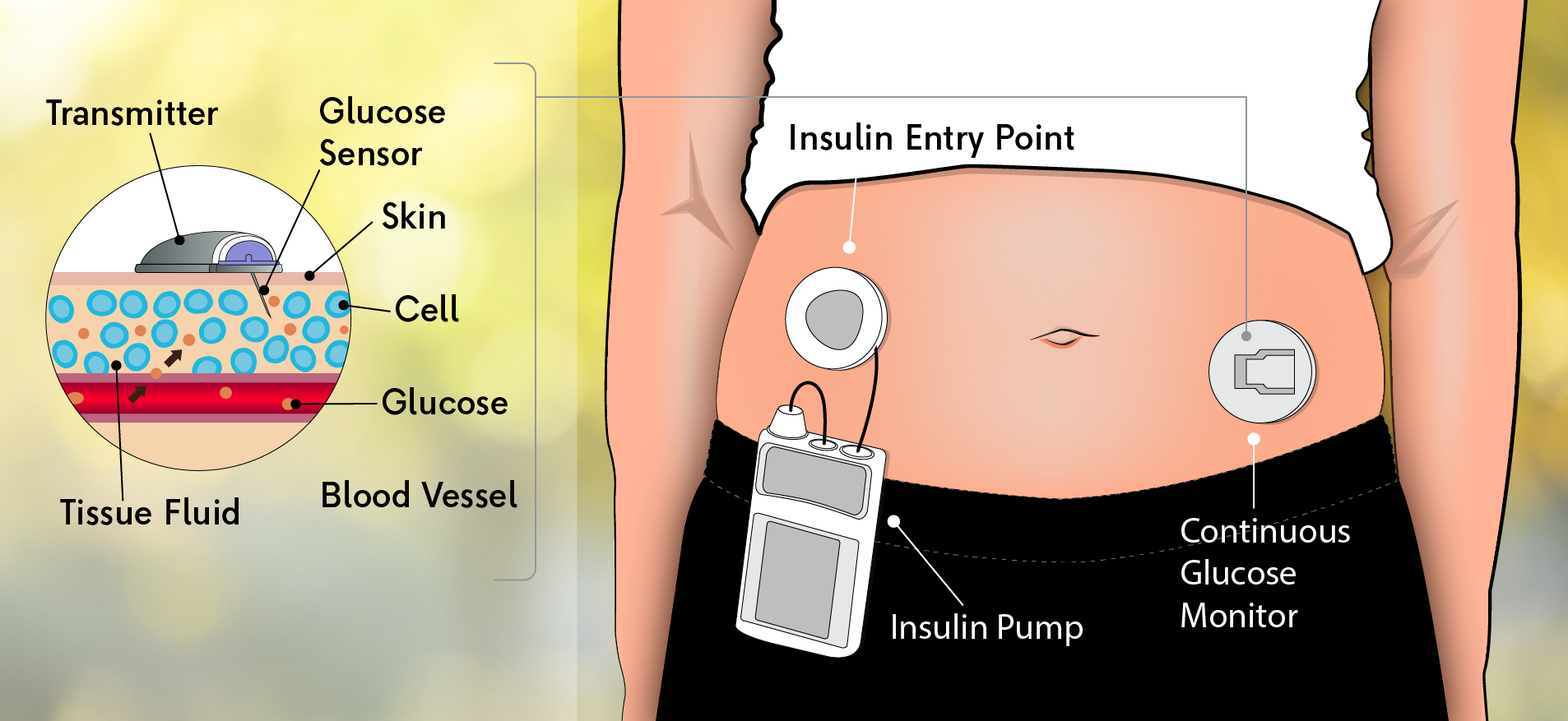 Diabetes Treatment Options Draelos Metabolic Center